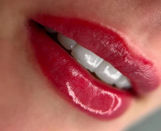 Beautiful full red lips showcasing enhanced volume and natural shine from professional lip filler treatment results.