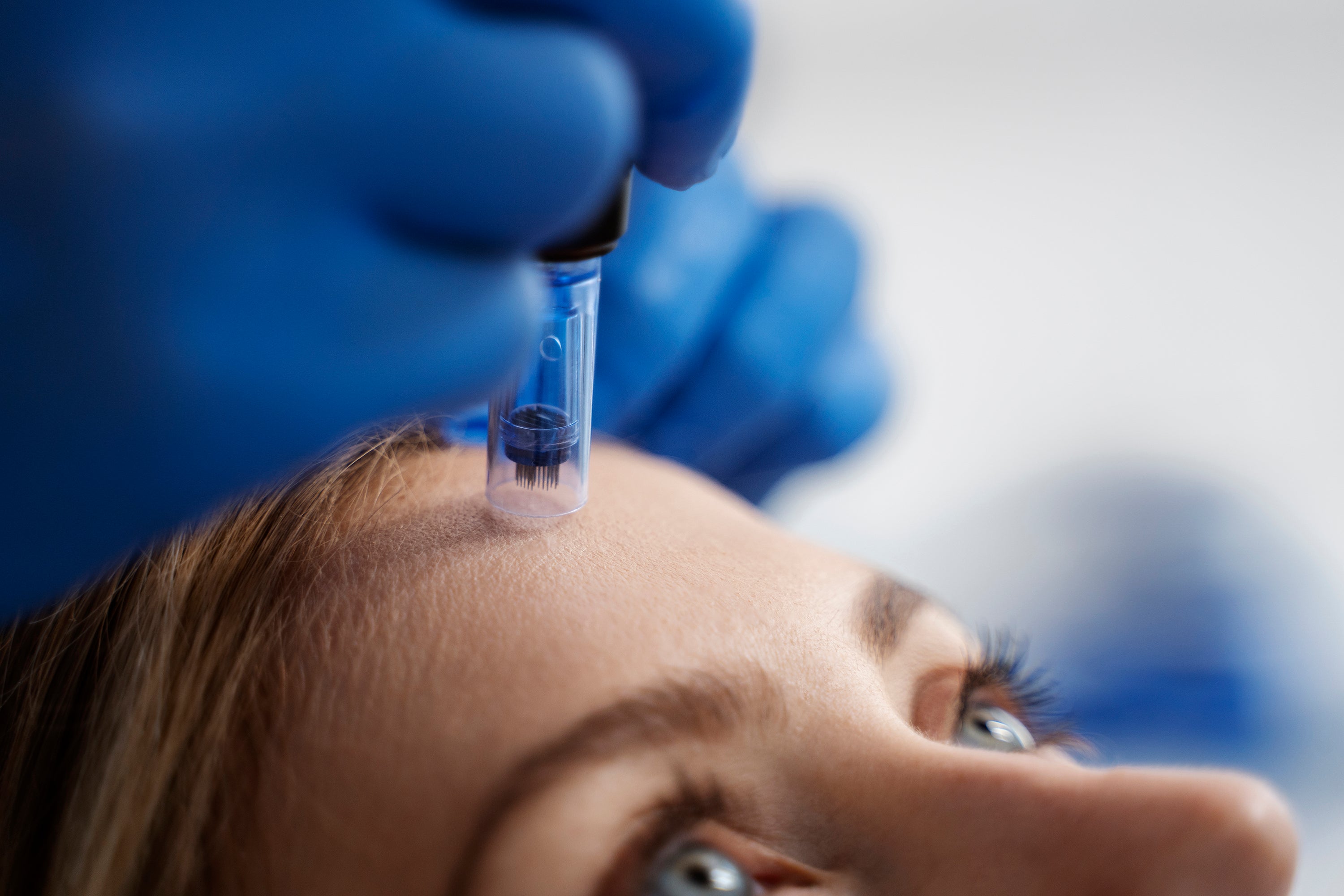 At-Home Microneedling vs. Professional Treatments: What's Best for Your Skin?